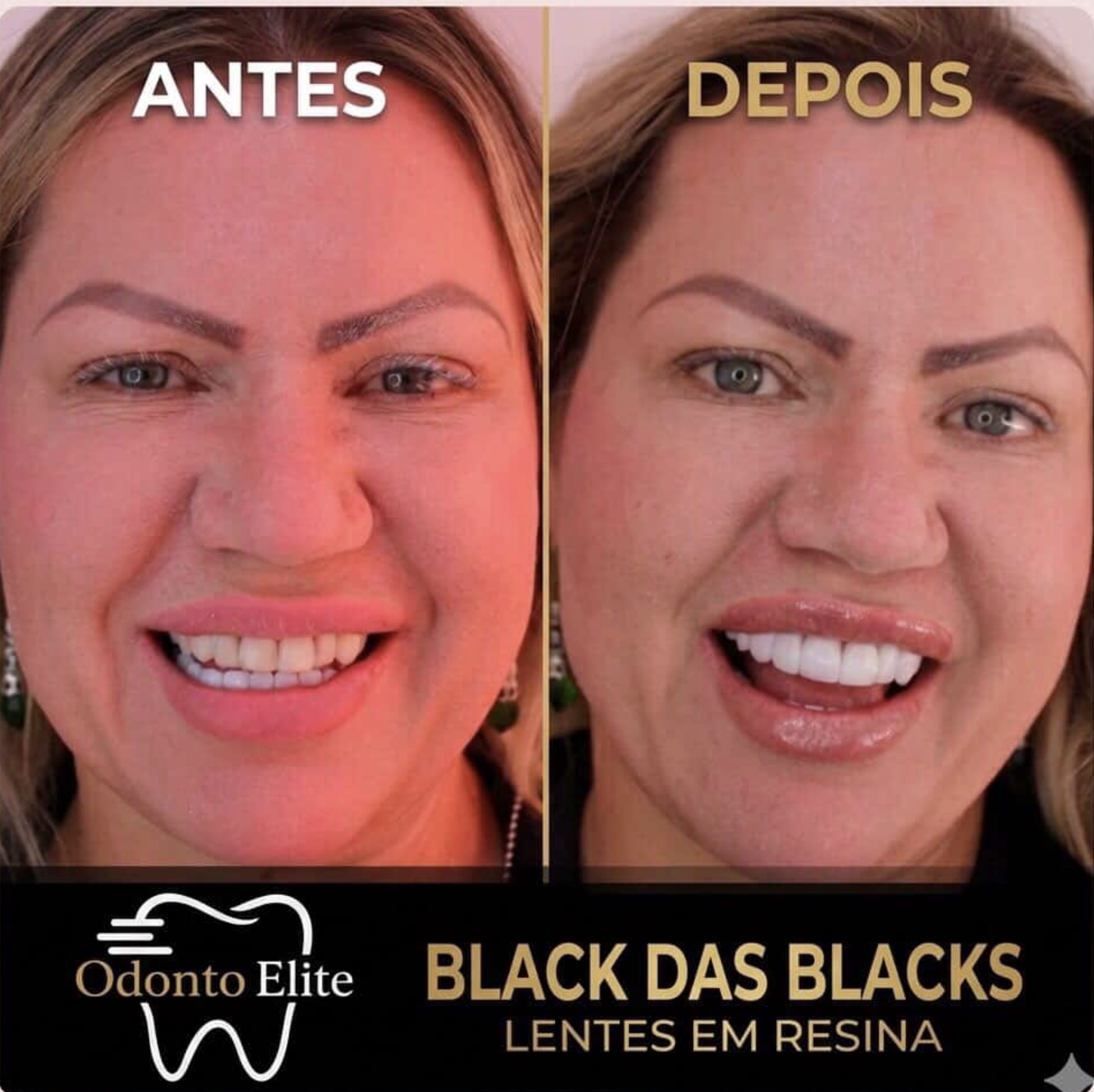 Sorriso com acabamento estético premium